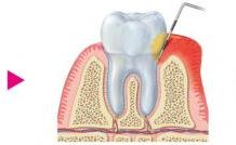 Preventing oral biofilm-induced periodontal disease