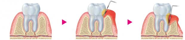 Preventing oral biofilm-induced periodontal disease