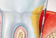 Periodontitis diagram