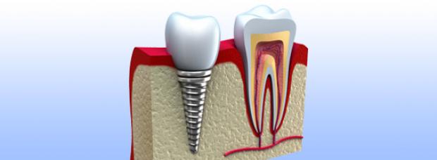 Prevalence, Diagnosis, and Treatment of Periimplantitis